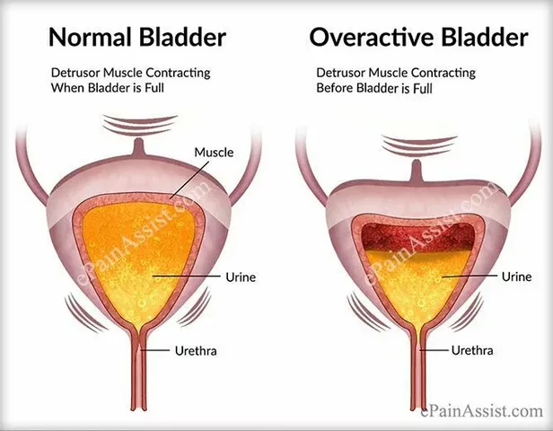 How Darifenacin Helps in Managing Overactive Bladder Symptoms