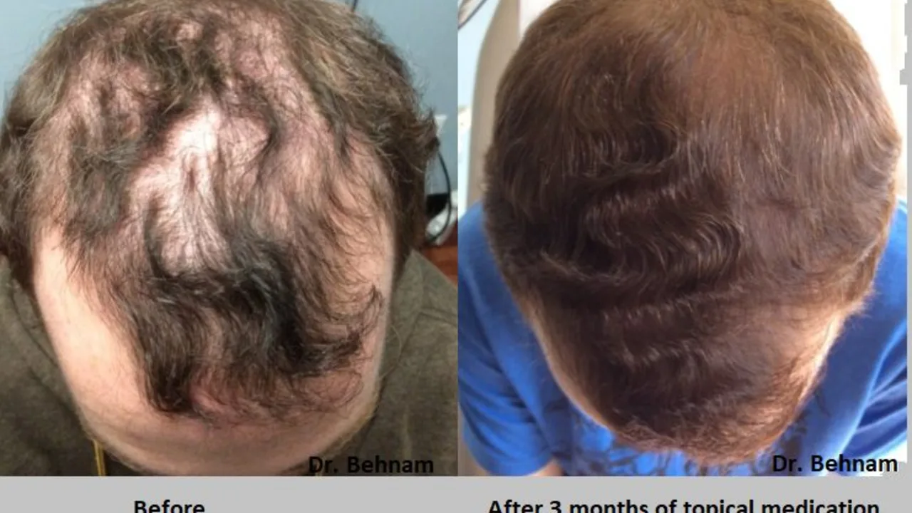 Purchase Propecia Online - Affordable and Reliable Hair Loss Solution
